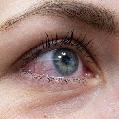 dry-eye-treatment